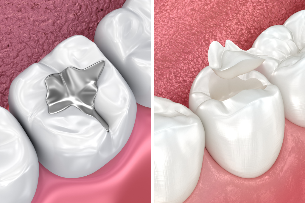 Dental Filling (1)