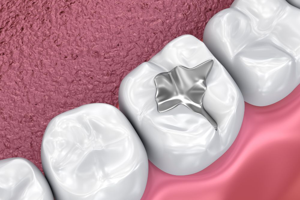 Dental Filling