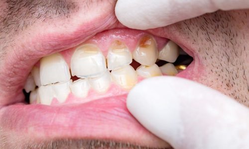Better Oral Health Better Oral Health