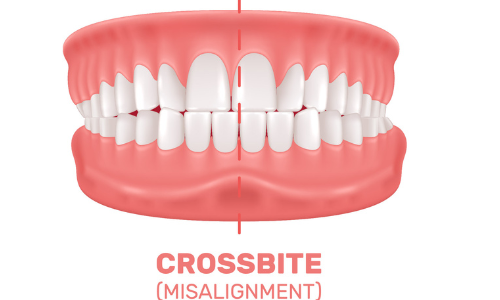 Cross bite Cross bite