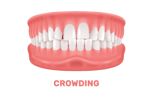 Crowding Crowding