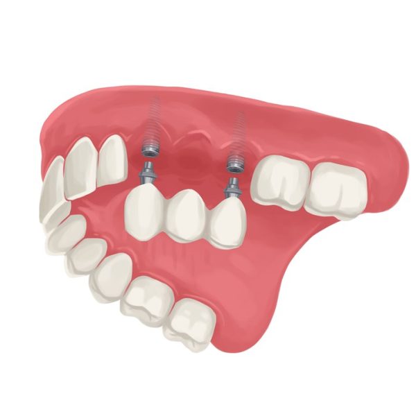 Dental Bridge Page Dental Bridge Page