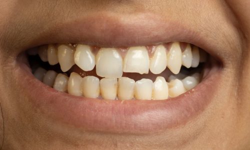 Misshapen Teeth Misshapen Teeth