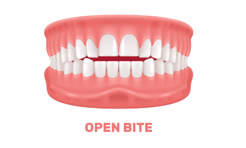 Open Bite Open Bite