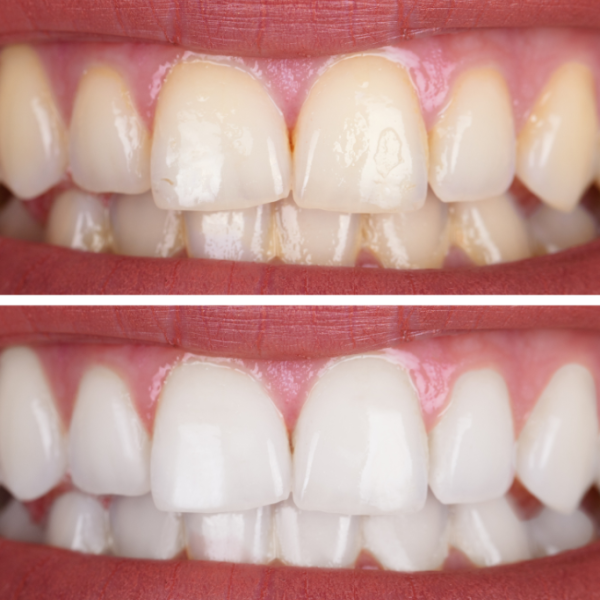 Teeth Whitening Teeth Whitening
